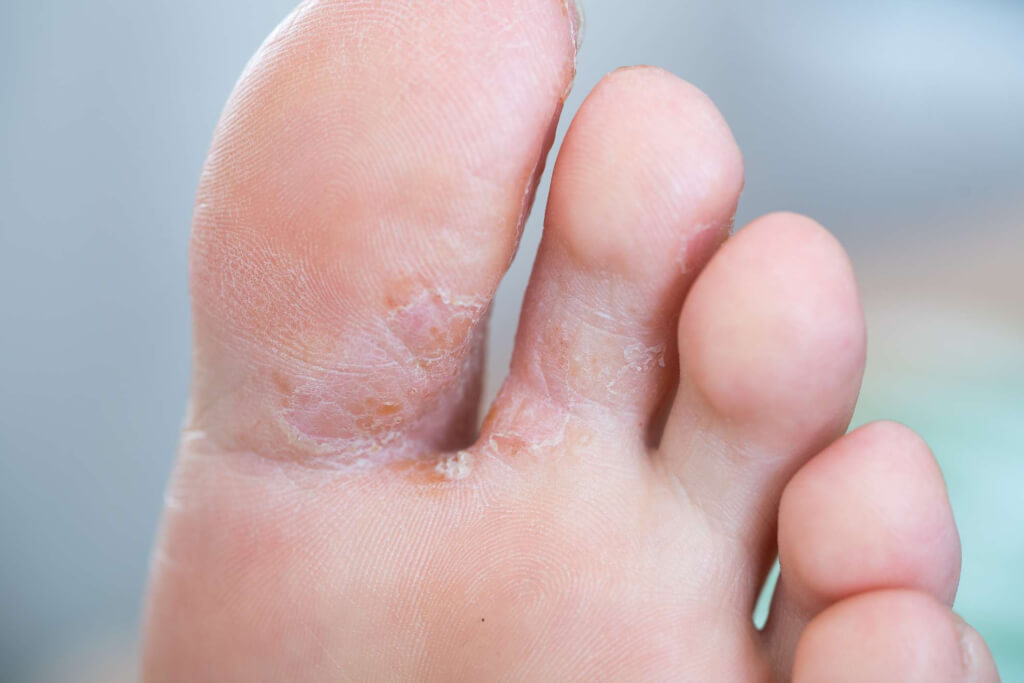top of feet itch at night