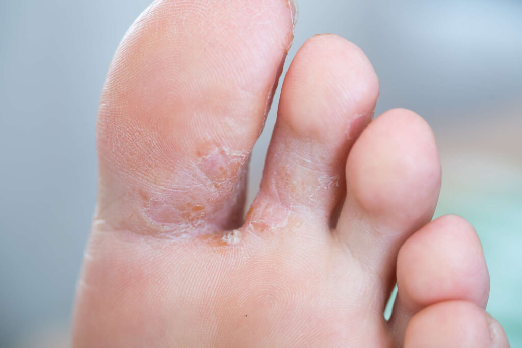 What Can Cause Your Feet To Itch At Night