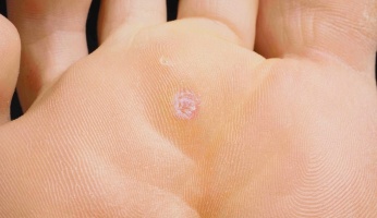 An in depth guide on foot & plantar wart removal in 2018