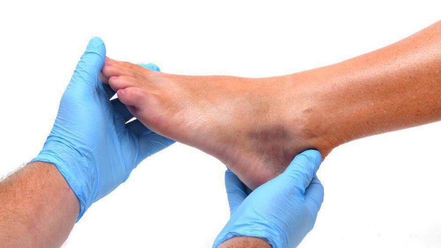 foot burisitis
