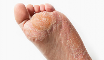 How to Get Rid of Hard Skin on Feet Quick