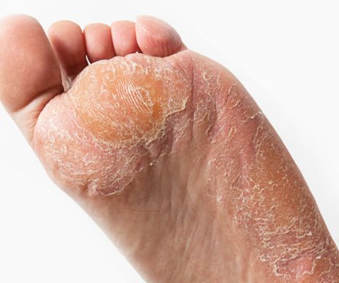 How to Get Rid of Hard Skin on Feet Quick