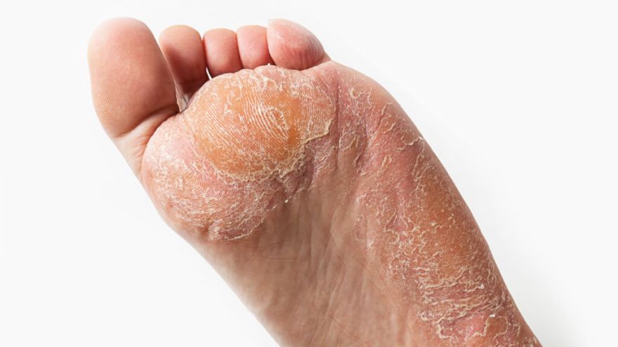 How to get Rid of Hard Skin on Feet