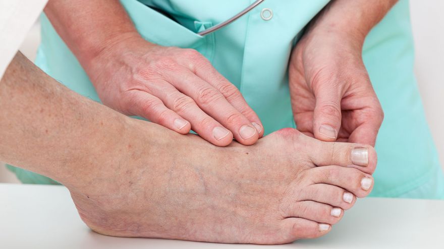 Home Remedies to Treat, Exercise, and Prevent Bunions