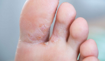 Why Do My Feet Itch at Night?